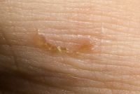 Potencial de los aceites esenciales en el tratamiento de la sarna