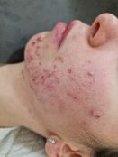 Plantas medicinales para el acné vulgar